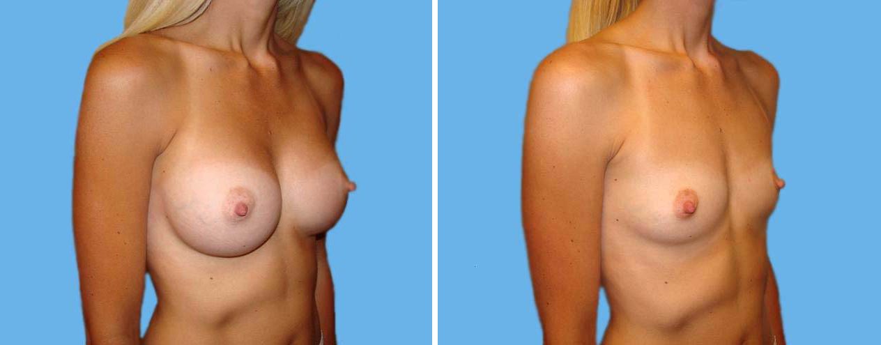 Breast Augmentation 1