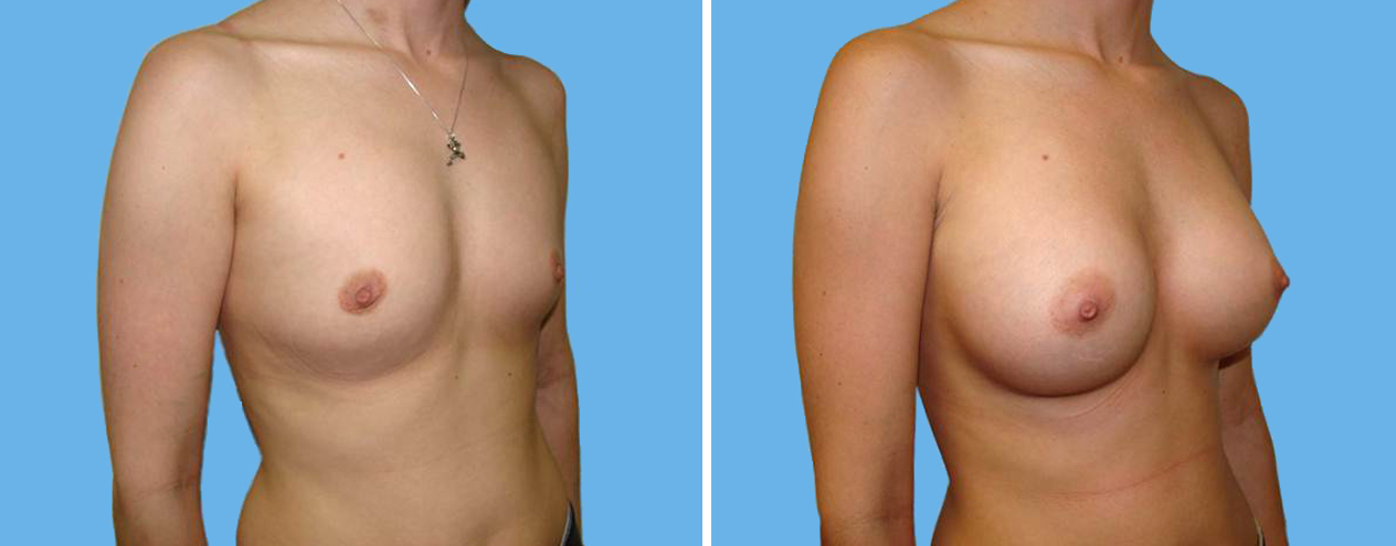 Breast Augmentation 3