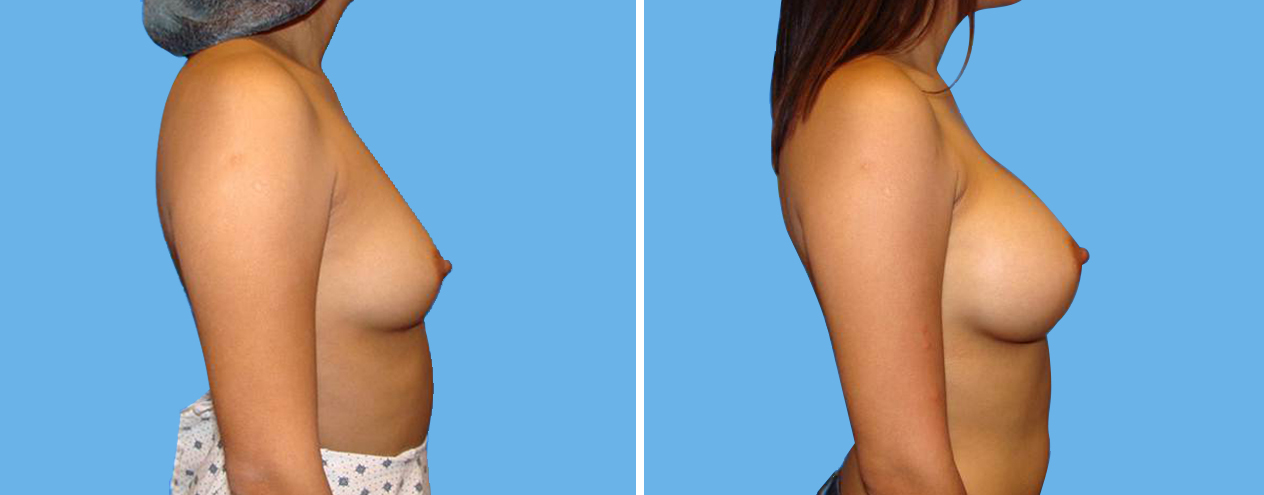 Breast Augmentation 4