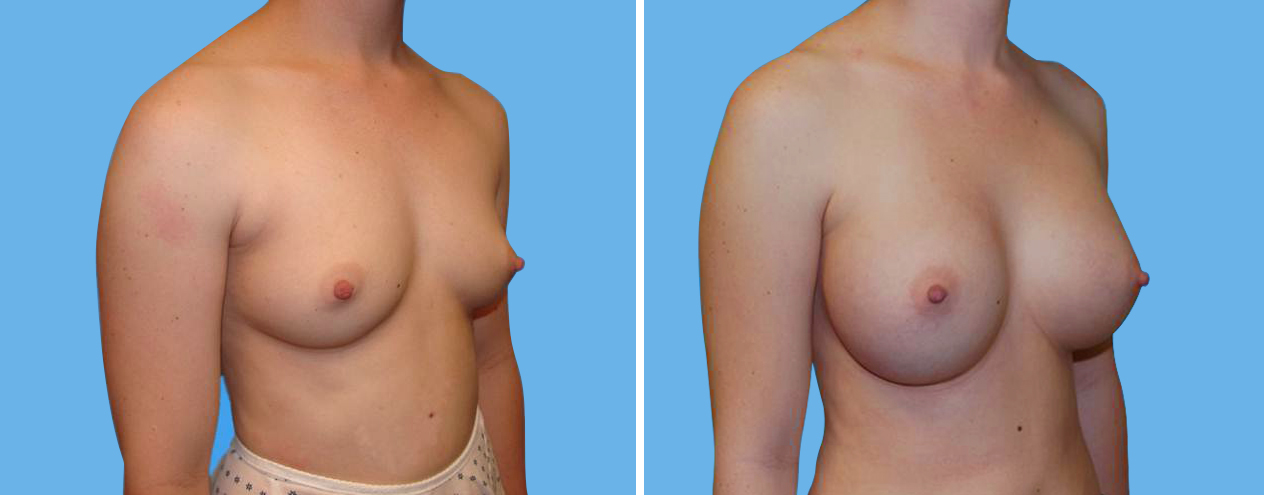 Breast Augmentation 5