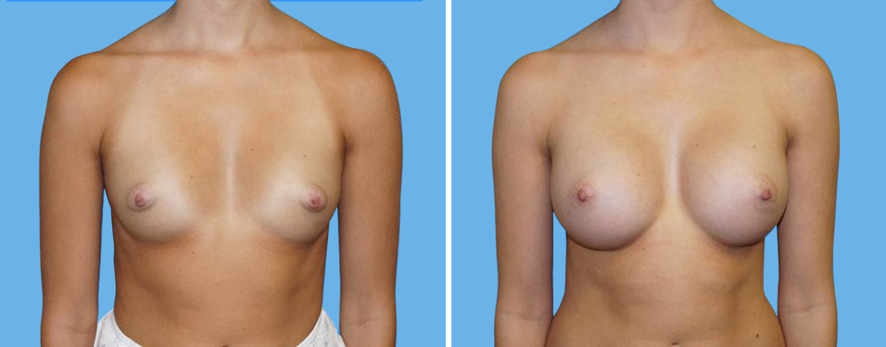 Breast Augmentation 6