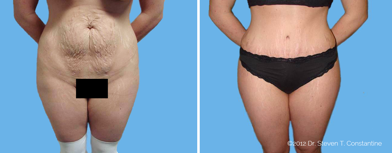 Liposuction / Liposculpture – Constantine Cosmetic Surgery