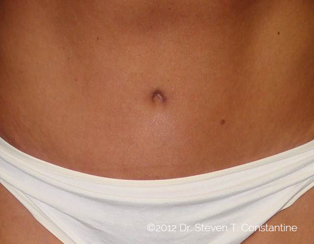 Scar_bellybutton_1