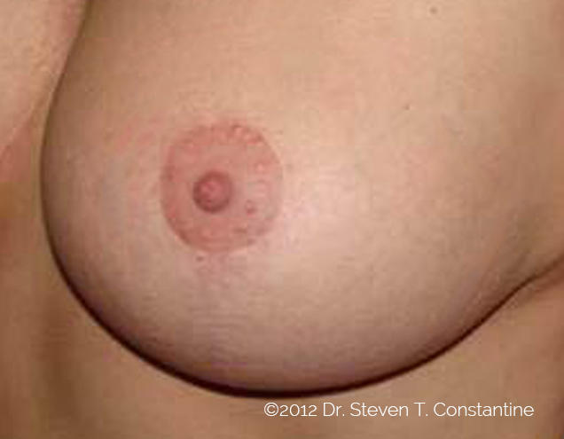 Scar_breast_3