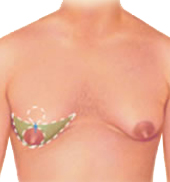 Gyne incision 2