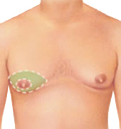 Gyne incision 3