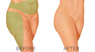 Liposuction / Liposculpture – Constantine Cosmetic Surgery