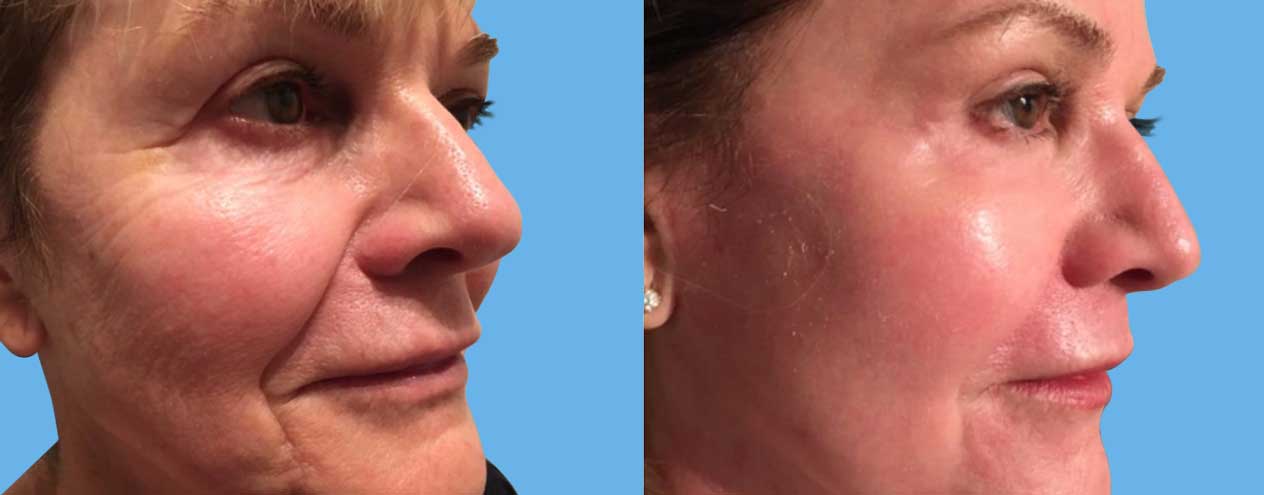 FRACTIONAL CO2 LASER-SKIN-RESURFACING