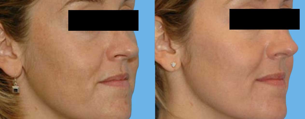 London Medical Spa - CO2 LASER RESURFACING 2/15/22. - Dr. Hal London Here  is another aggressive CO2 laser treatment of the face. This lovely patient  of mine asked me what would make