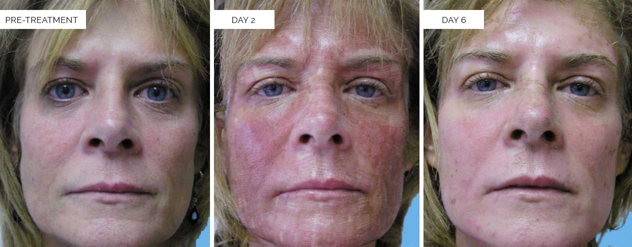 FRACTIONAL CO2 LASER-SKIN-RESURFACING