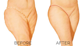 Thigh incisions_1