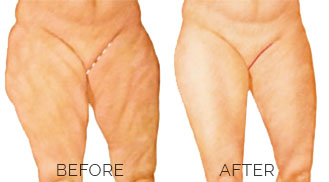 Thigh incisions_2
